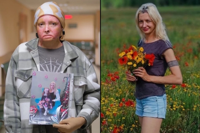 Инна Цыбасова пережила кому, адскую боль и десятки операций. Фото: Дмитрий РОЖДЕСТВЕНСКИЙ / ВКонтакте