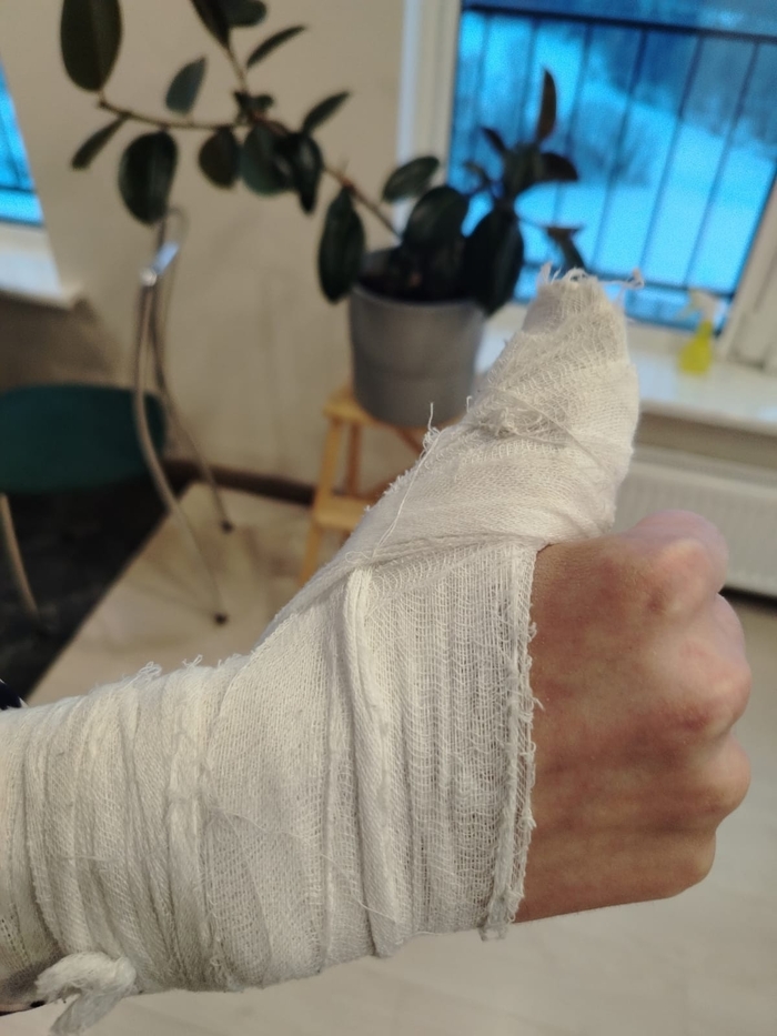 Через полгода, можно заявить, что перелома не было вовсе, а это значит и потери трудоспособности не было! То, что ребёнок был лишён возможности писать и выполнять физические упражнения не считается! Это ведь всё по нашему МНЕ-НИ-Ю и по нашему ВИ-ДЕНЬ-Ю!